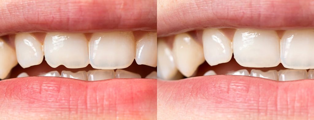 Before and after composite bonding treatment in exeter