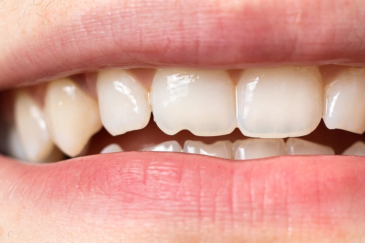Composite Bonding in Exeter