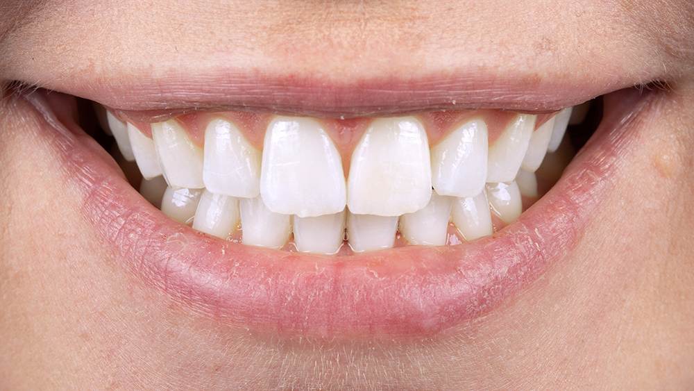 Whitened Teeth